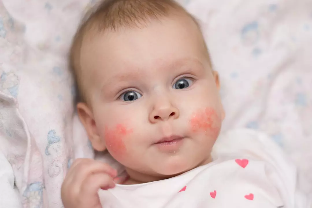 How to manage dermatitis in babies and toddlers