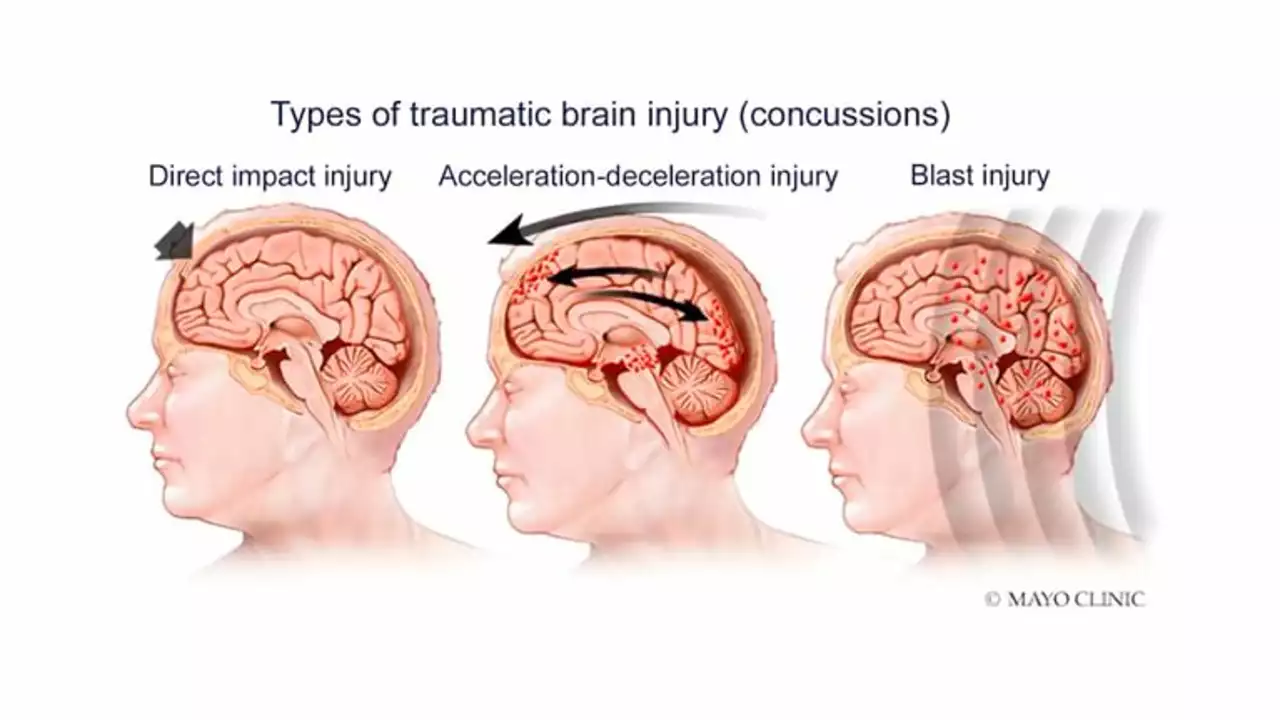 The role of tranexamic acid in the treatment of traumatic brain injury