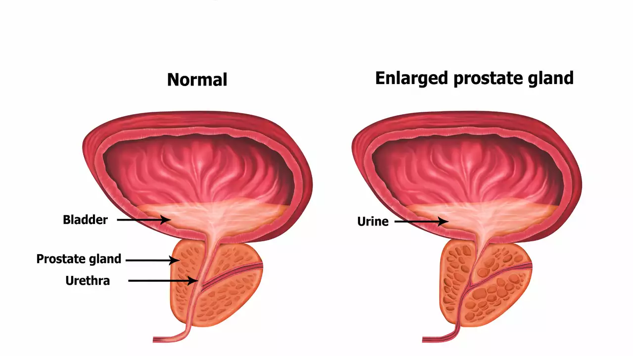 The Impact of Benign Prostatic Hyperplasia on Quality of Life