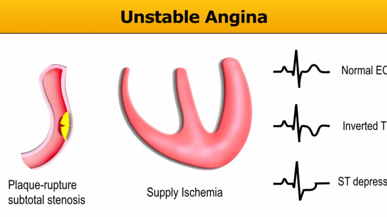 Unstable Angina: What You Need to Know and How to Manage It